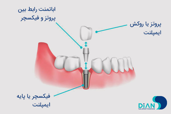 ایمپلنت دندان