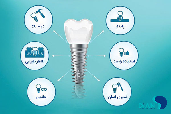 مزایای ایمپلنت دندان