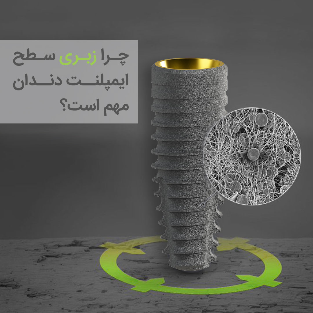 زبری سطح ایمپلنت دندان