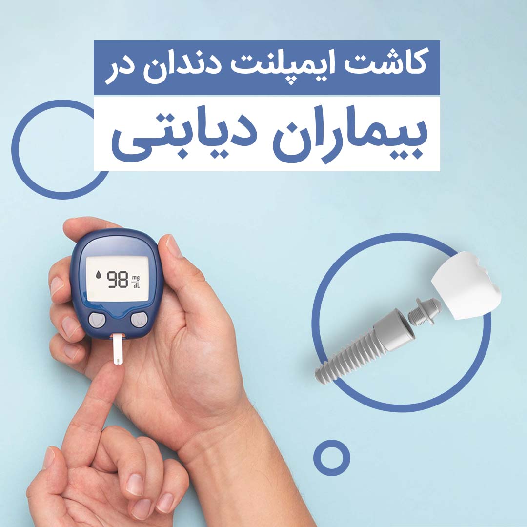 کاشت ایمپلنت دندان در بیماران دیابتی ایمپلنت دندان در بیماران دیابتی