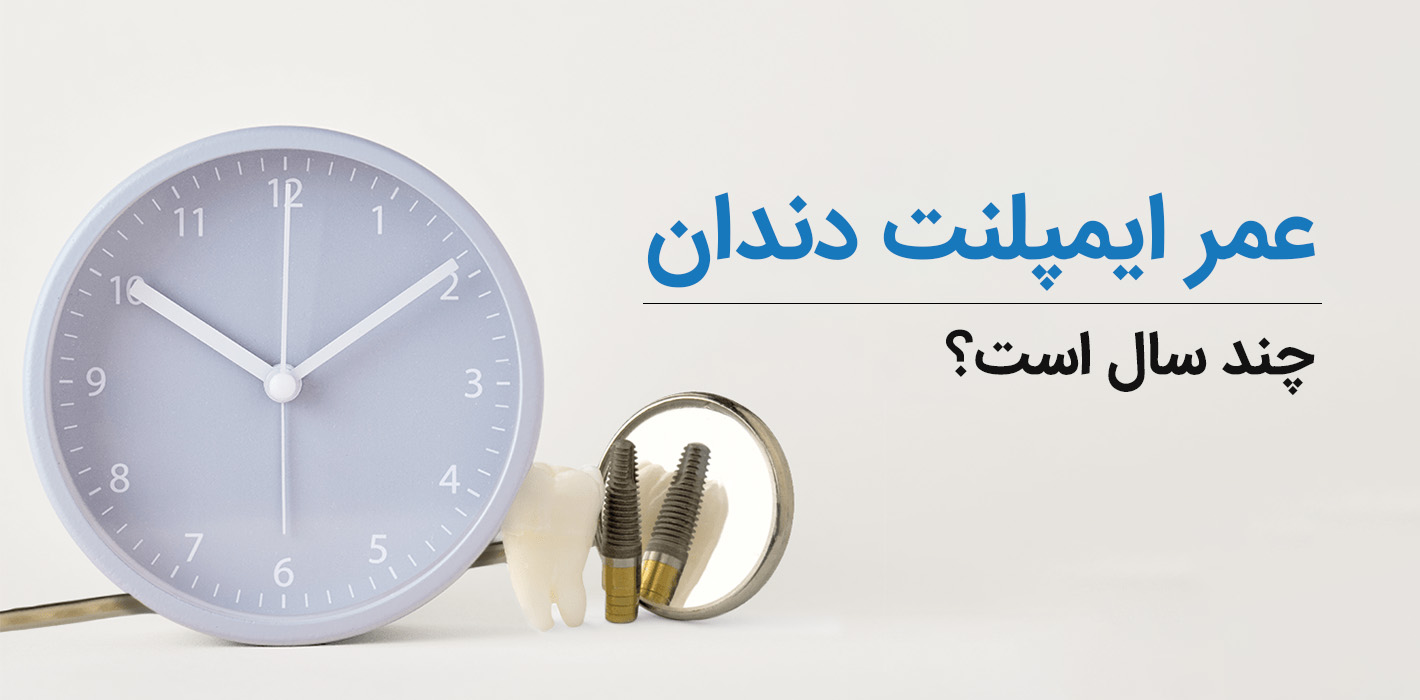 عمر ایمپلنت دندان