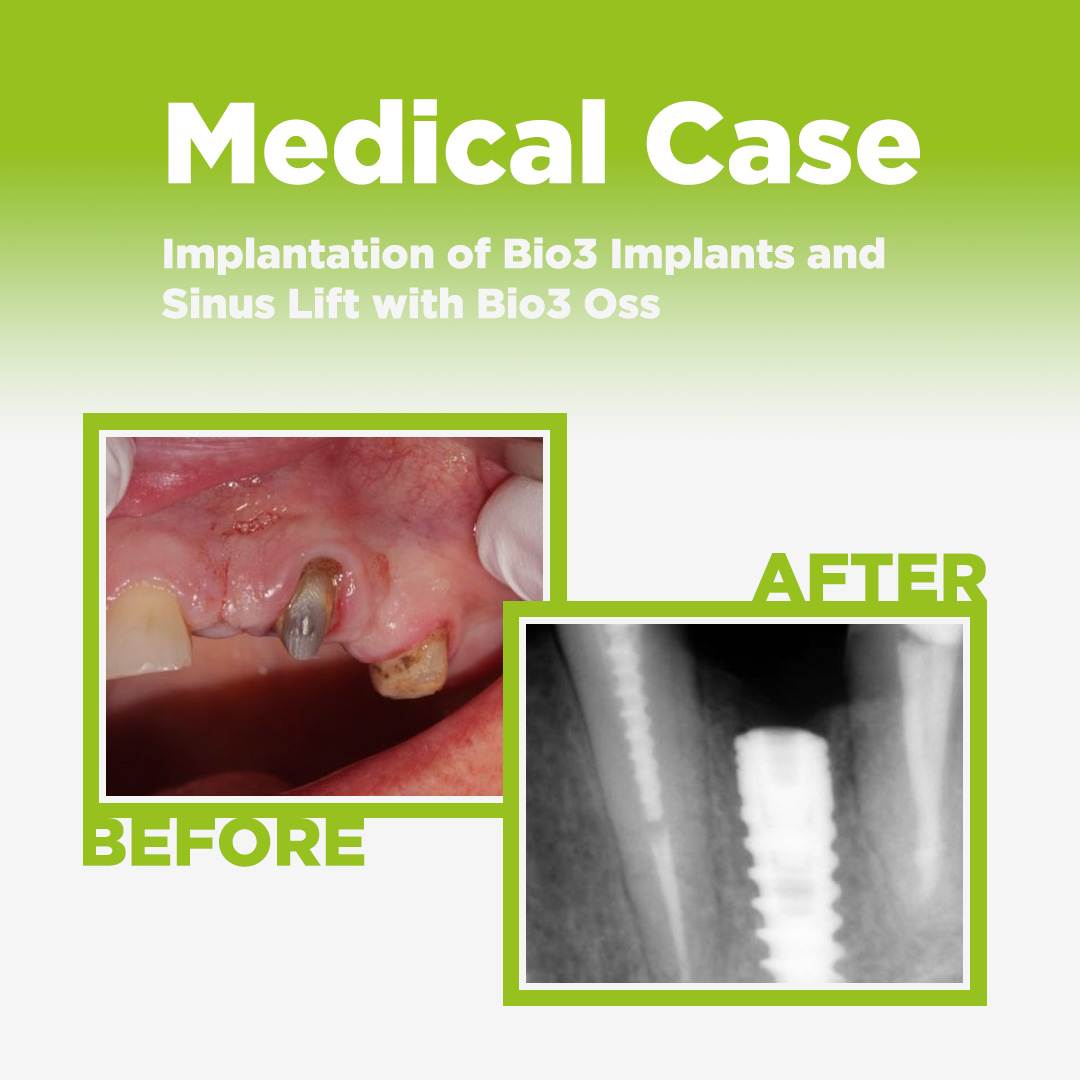Medical Case: Minimally Invasive Implantation of Bio3 Implants and Sinus-Lift with Bio3 Oss Implantation of Bio3 Implants and Sinus Lift with Bio3 Oss