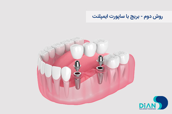 بریج با ساپورت ایمپلنت