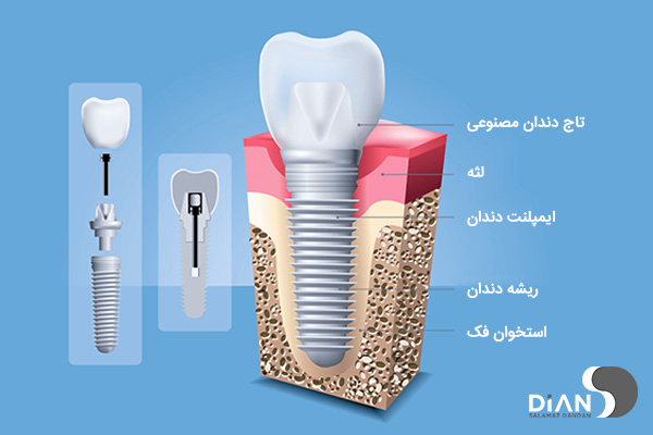 ایمپلنت دندان