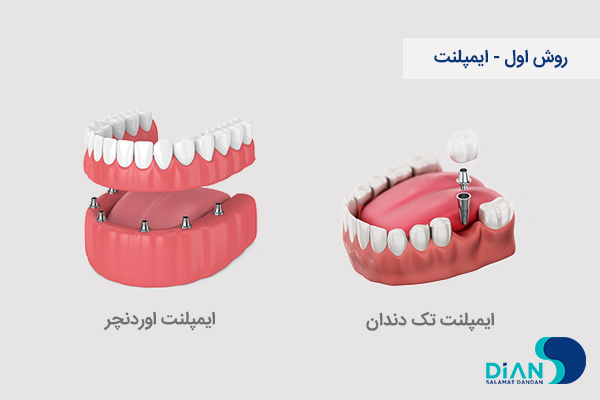 ایمپلنت دندان