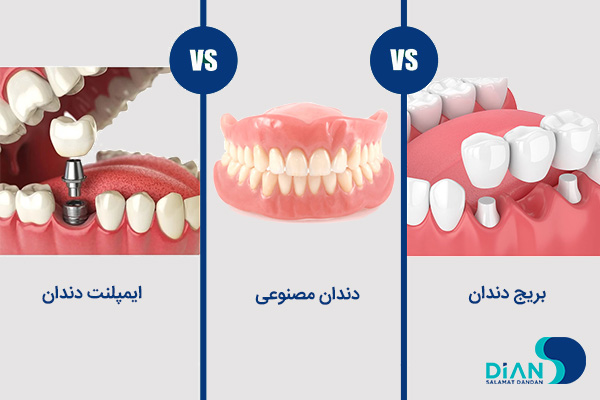 بریج دندان