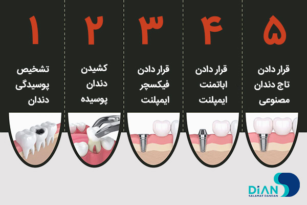 مراحل ایمپلنت دندان