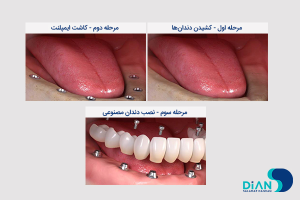 مراحل اوردنچر