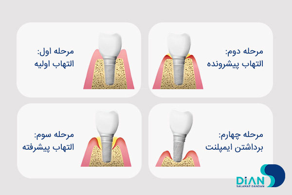 پری ایمپلنتیت