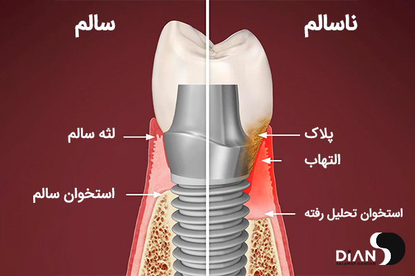 پری ایمپلنتیت