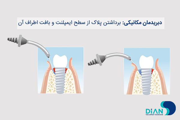 پری ایمپلنتیت