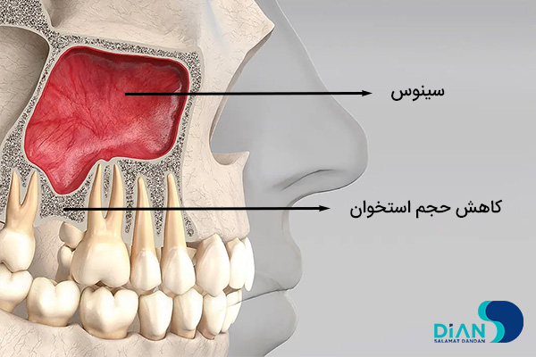 سینوس لیفت