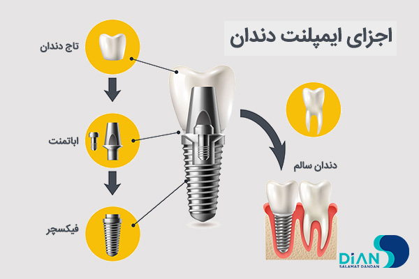 اجزای ایمپلنت دندان