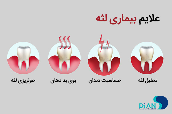 علایم بیماری لثه