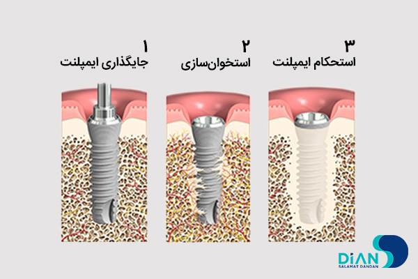 استخوان سازی اطراف ایمپلنت