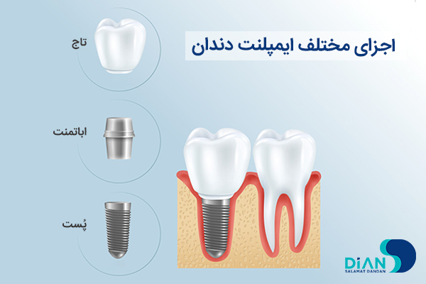 اجزای مختلف ایمپلنت دندان