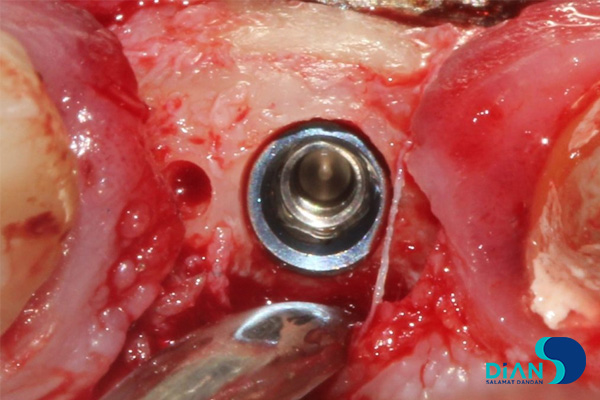 postponed implantation with immediate loading