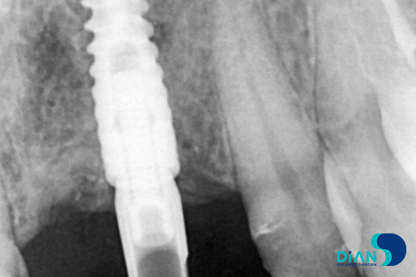 postponed implantation with immediate loading