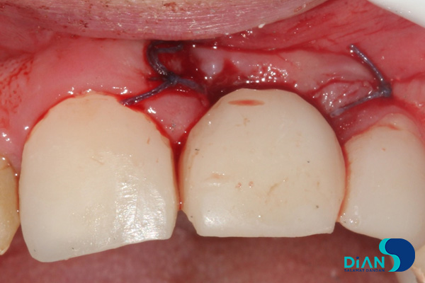 postponed implantation with immediate loading