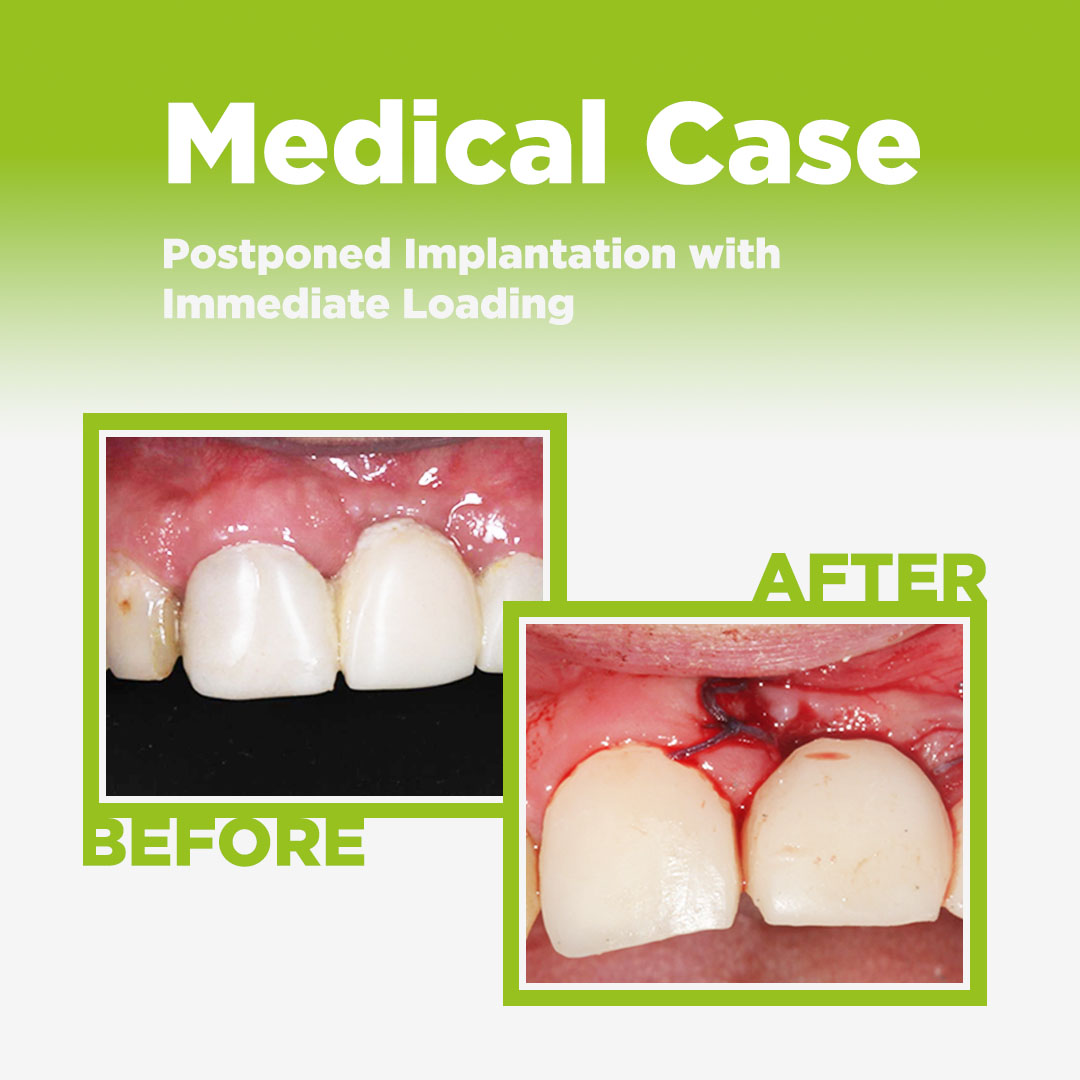 postponed implantation with immediate loading