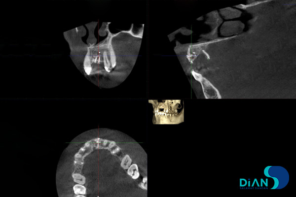 postponed implantation with immediate loading