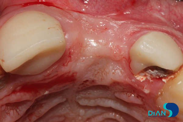 postponed implantation with immediate loading