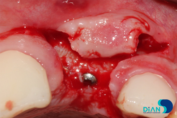 postponed implantation with immediate loading