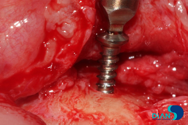 postponed implantation with immediate loading