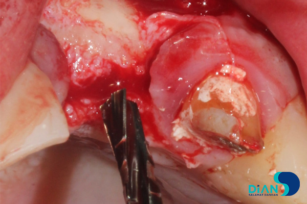 postponed implantation with immediate loading