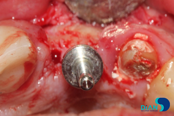 postponed implantation with immediate loading