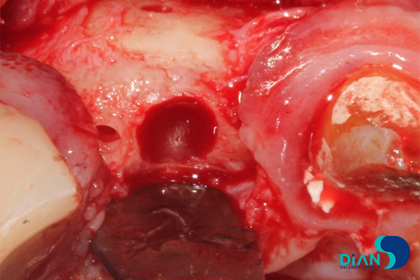 postponed implantation with immediate loading