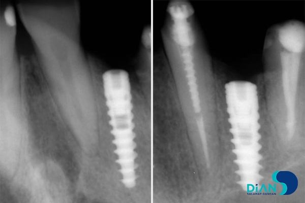 Great results with Bio3 implant and sinus lifting (one pack Bio3 Oss) the of dental implantation were achieved