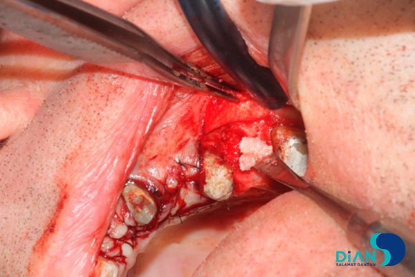 A bone was mixed with autologous bone and lifted the membrane in the sinus