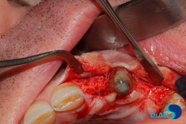 Incision at the top of the alveolar ridge with peeled of periosteal flap