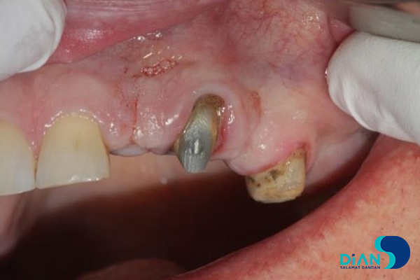 Patient with edentulous in No. 22, 24, 26 teeth