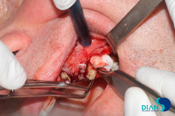 The dentist used Bio3 synthetic bone graft which stimulate bone cell regeneration