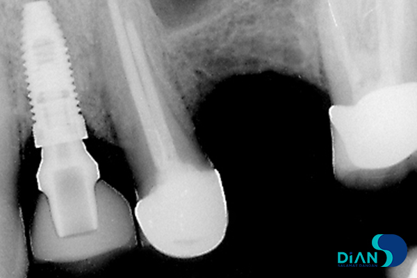 رادیوگرافی از ایمپلنت دندان