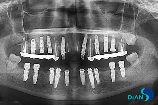 رادیوگرافی از ایمپلنت دندان