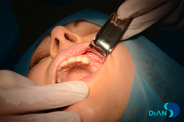 Implantation on the Maxilla