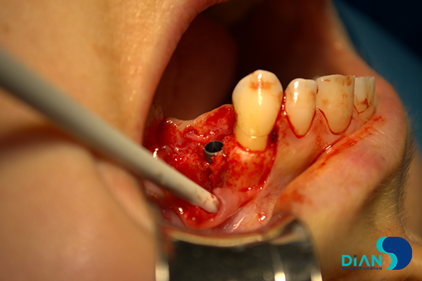 Implantation on the Maxilla