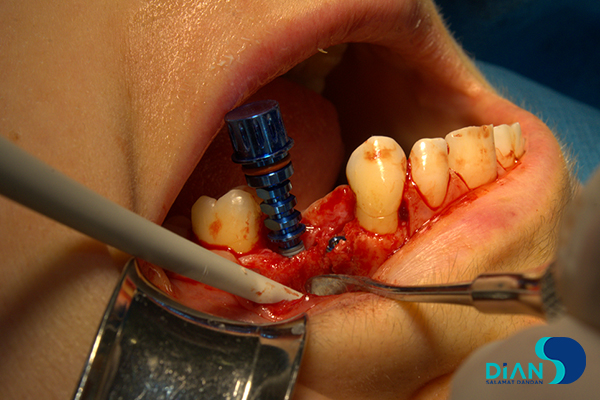 Implantation on the Maxilla