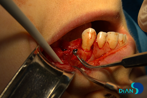 Implantation on the Maxilla