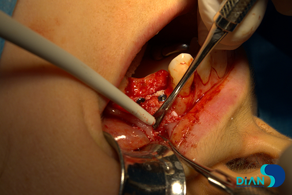 Implantation on the Maxilla