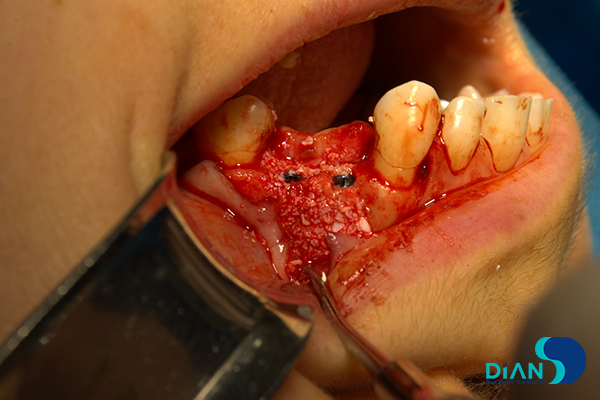 Implantation on the Maxilla