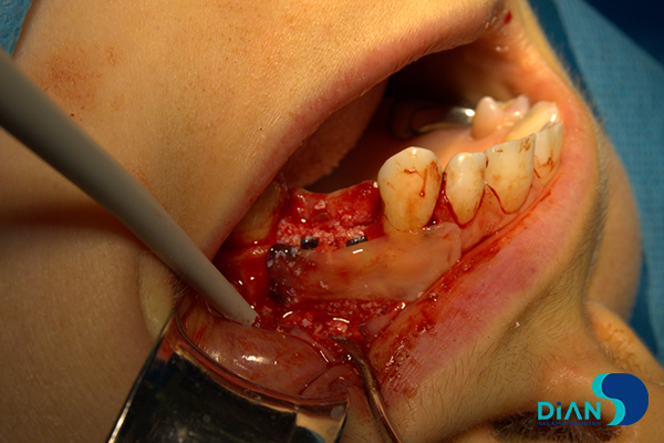 Implantation on the Maxilla