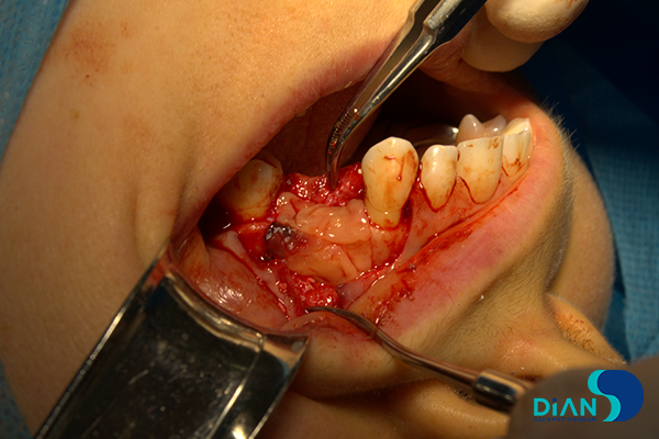 Implantation on the Maxilla