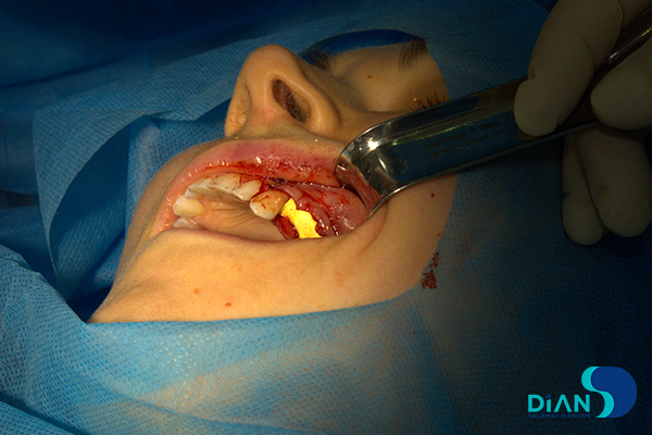 Implantation on the Maxilla