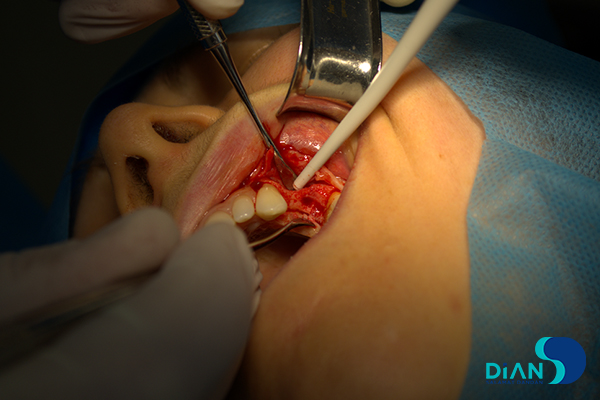 Implantation on the Maxilla