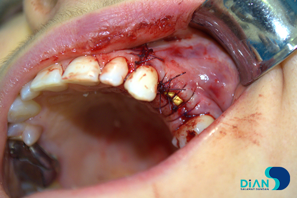 Implantation on the Maxilla