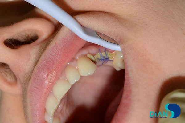 Implantation on the Maxilla